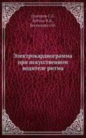 Elektrokardiogramma pri iskusstvennom voditele ritma