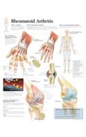 Rheumatoid Arthritis Laminated Poster