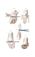 Amputations in the Continuity of the Bones Notebook