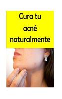 Cura tu acné naturalmente