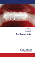 Tooth agenesis