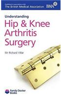 Understanding Hip & Knee Arthritis Surgery