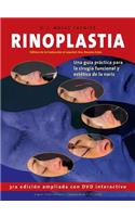 Rinoplastia