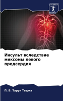 Инсульт вследствие миксомы левого предсе