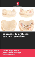 Conceção de próteses parciais removíveis