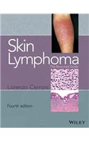 Skin Lymphoma