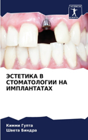 ЭСТЕТИКА В СТОМАТОЛОГИИ НА ИМПЛАНТАТАХ