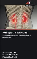 Nefropatia da lupus