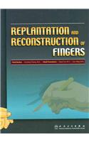 Replantation and Reconstruction of Fingers