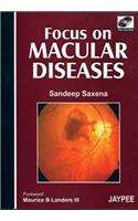 Focus on Macular Diseases