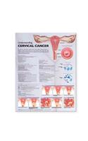 Understanding Cervical Cancer Anatomical Chart