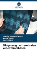 Bildgebung bei zerebralen Venenthrombosen