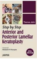 Step by Step Anterior and Posterior Lamellar Keratoplasty (with DVD-ROM)