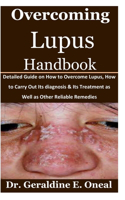 Overcoming Lupus Handbook: Detailed Guide on How to Overcome Lupus, How to Carry Out Its diagnosis & Its Treatment as Well as Other Reliable Remedies