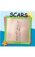 Scars