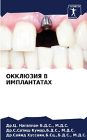 ОККЛЮЗИЯ В ИМПЛАНТАТАХ