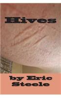 Hives