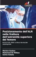 Posizionamento dell'ALR nelle fratture dell'estremità superiore del femore