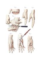 Disarticulation of the Four Fingers and of the Thumb