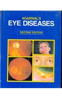 Eye Diseases