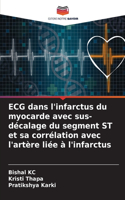 ECG dans l'infarctus du myocarde avec sus-décalage du segment ST et sa corrélation avec l'artère liée à l'infarctus