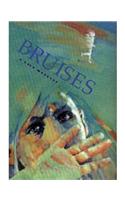Bruises