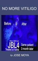 No More Vitiligo