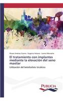tratamiento con implantes mediante la elevación del seno maxilar