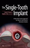 The Single-Tooth Implant