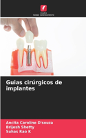 Guias cirúrgicos de implantes