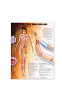 Deep Vein Thrombosis Anatomical Chart