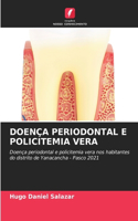 Doença Periodontal E Policitemia Vera