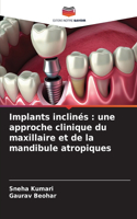 Implants inclinés