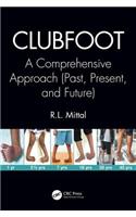 Clubfoot: A Comprehensive Approach (Past, Present, and Future)