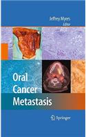 Oral Cancer Metastasis