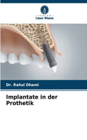 Implantate in der Prothetik
