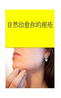 Cure Your Acne Certu
