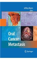 Oral Cancer Metastasis
