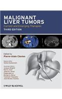 Malignant Liver Tumors