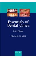 Essentials Of Dental Caries
