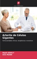 Arterite de Células Gigantes