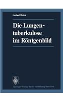 Die Lungentuberkulose Im Röntgenbild