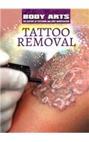 Tattoo Removal