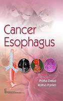Cancer Esophagus