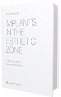 Implants in the Esthetic Zone: A Step-by-Step Treatment Strategy