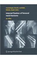 Internal Fixation of Femoral Neck Fractures