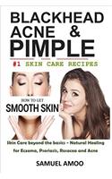 Blackheads, Acne & Pimple