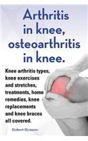 Arthritis in knee, osteoarthritis in knee. Knee arthritis types, knee exercises and stretches, treatments, home remedies, knee replacements and knee braces all covered.