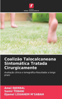 Coalizão Talocalcaneana Sintomática Tratada Cirurgicamente