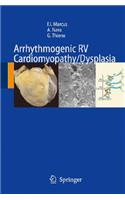 Arrhythmogenic RV Cardiomyopathy/Dysplasia